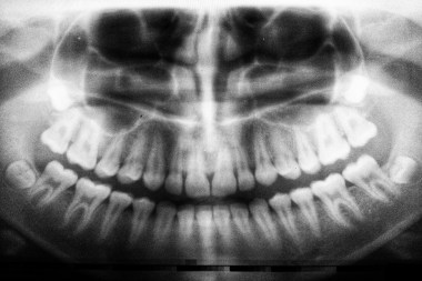 Dental X ray3